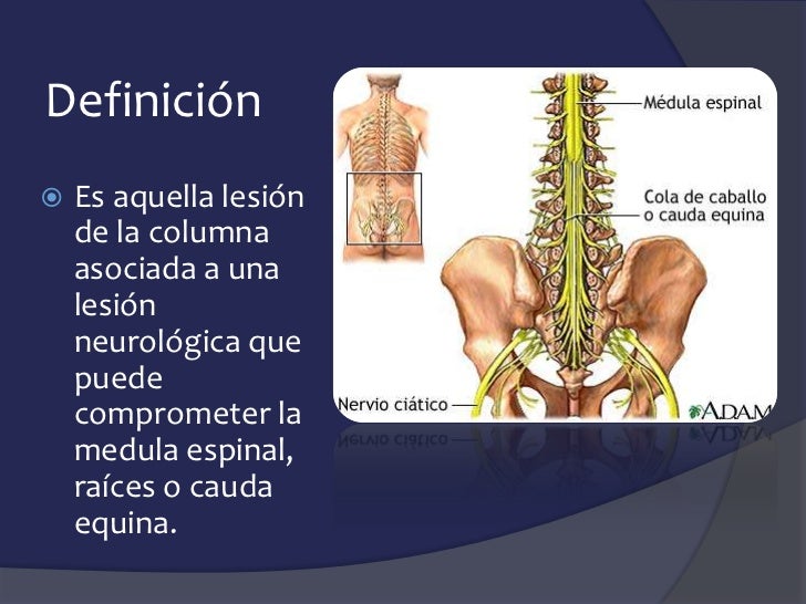 traumatismo raquimedular